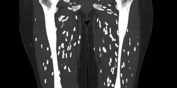 വേവിക്കാത്ത പന്നിയിറച്ചി കഴിച്ച് ഗുരുതരമായി അണുബാധയേറ്റ ഒരു രോഗിയുടെ സ്കാനുകളുമായി ഡോക്ടർ