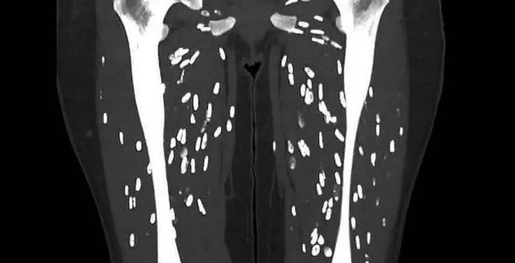 വേവിക്കാത്ത പന്നിയിറച്ചി കഴിച്ച് ഗുരുതരമായി അണുബാധയേറ്റ ഒരു രോഗിയുടെ സ്കാനുകളുമായി ഡോക്ടർ